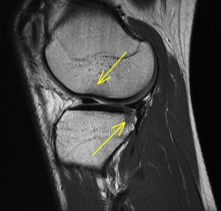 Figure 3 for case Capsular attachmet tear